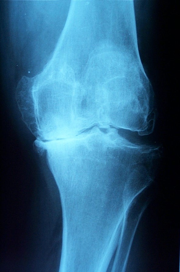 artrosi deformante del ginocchio - radiografia