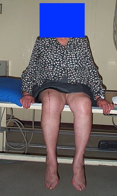 paziente con artrosi deformante del ginocchio