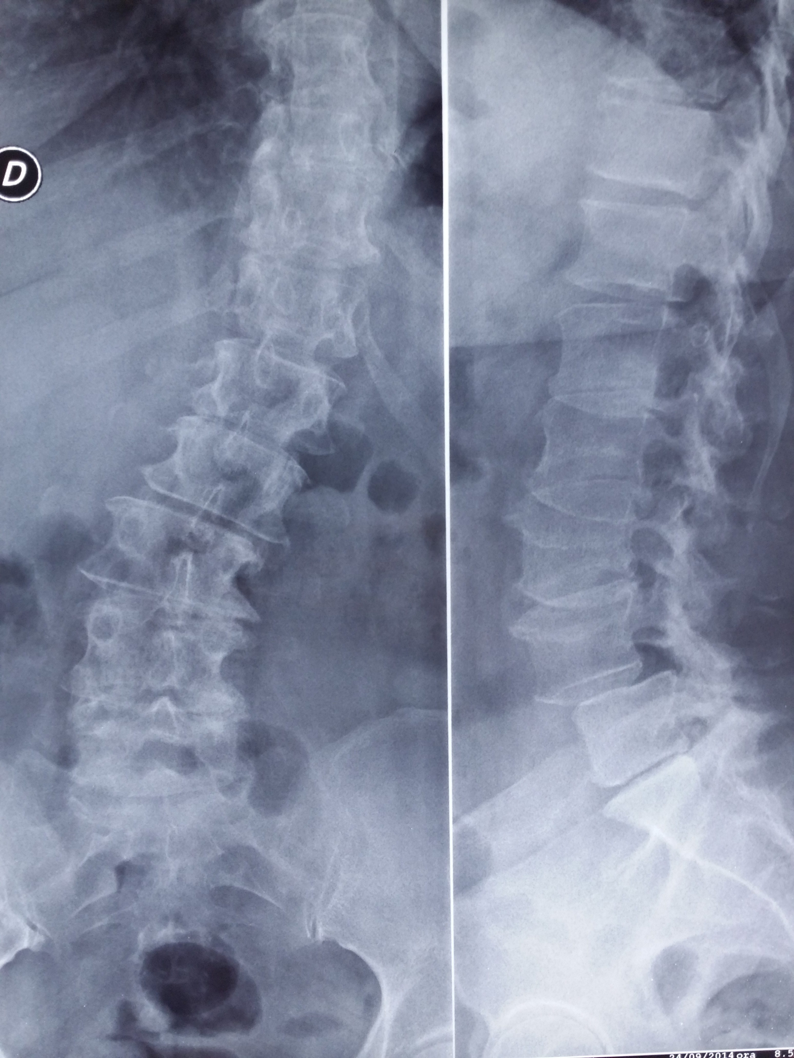 paziente con scoliosi e spondilolistesi