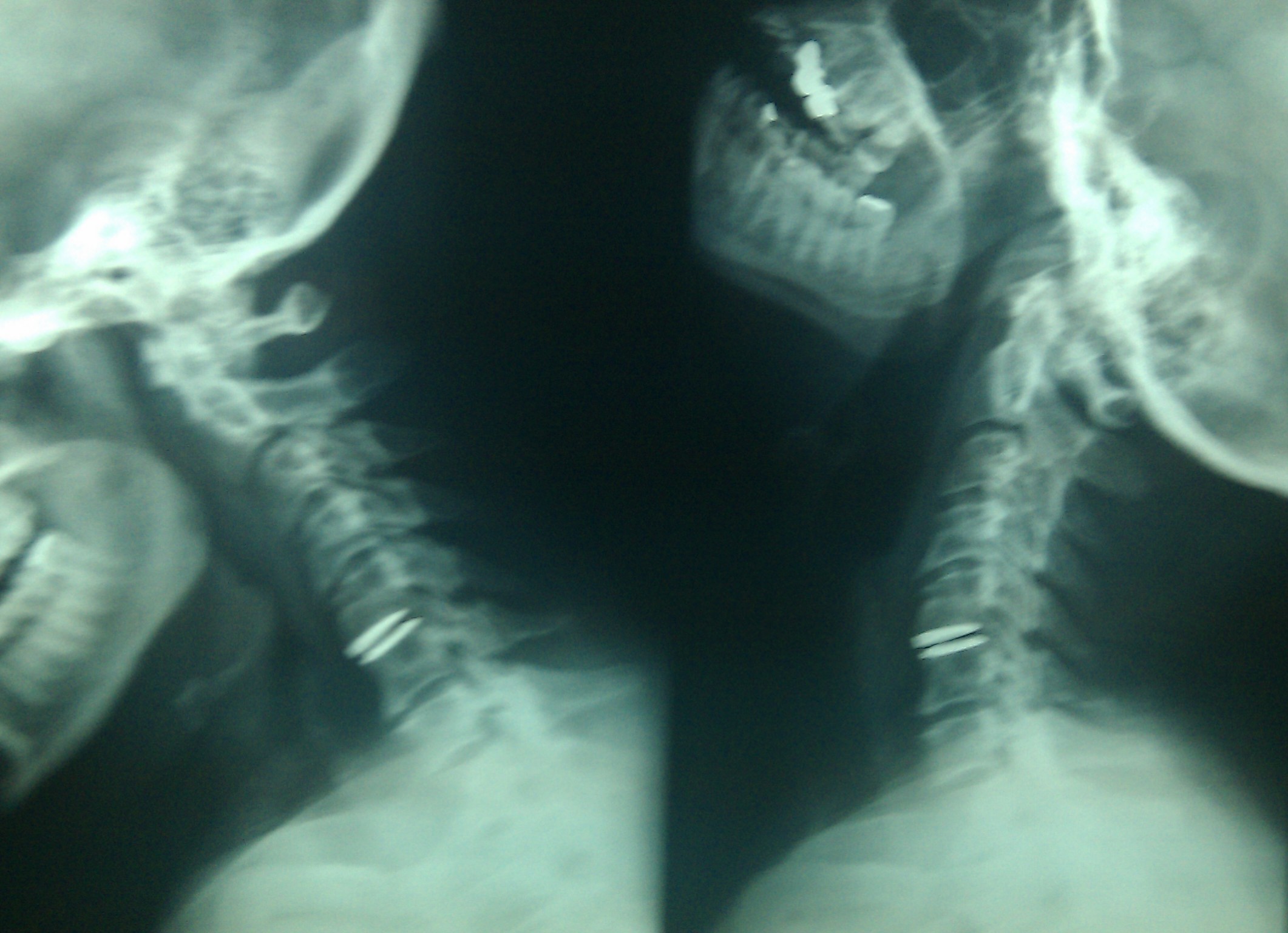 protesi disco cervicale - radiografie - paziente operato