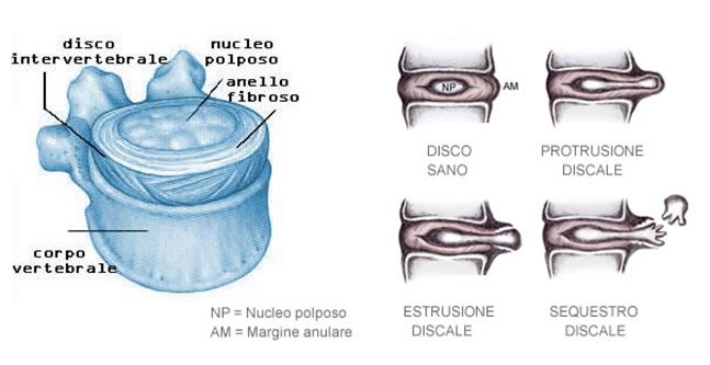 ernia - anulus fibroso - HT Clinic - Fisioterapia Ragusa