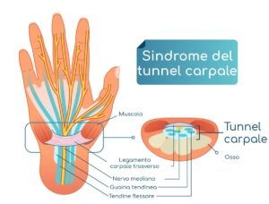 tunnel carpale