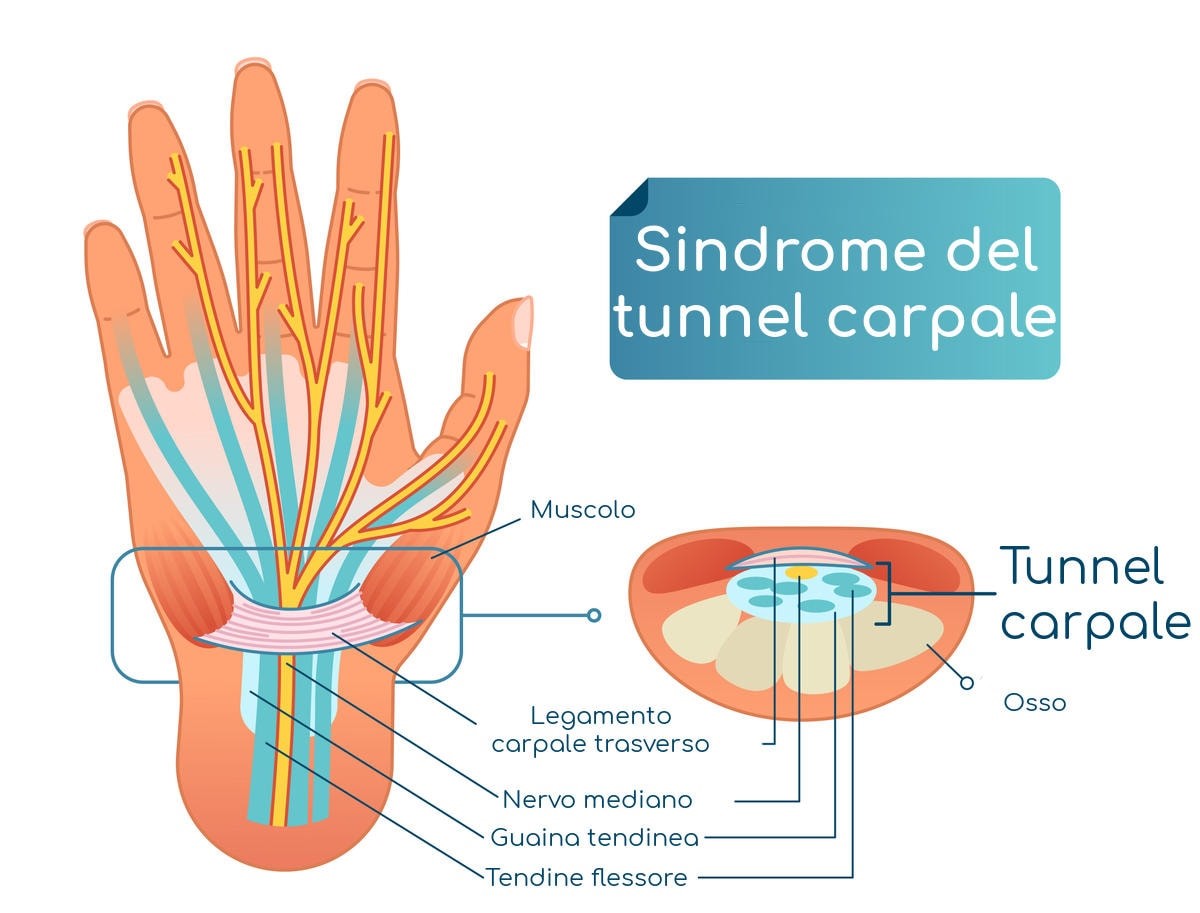 H.T. Clinic Ragusa - tunnel carpale